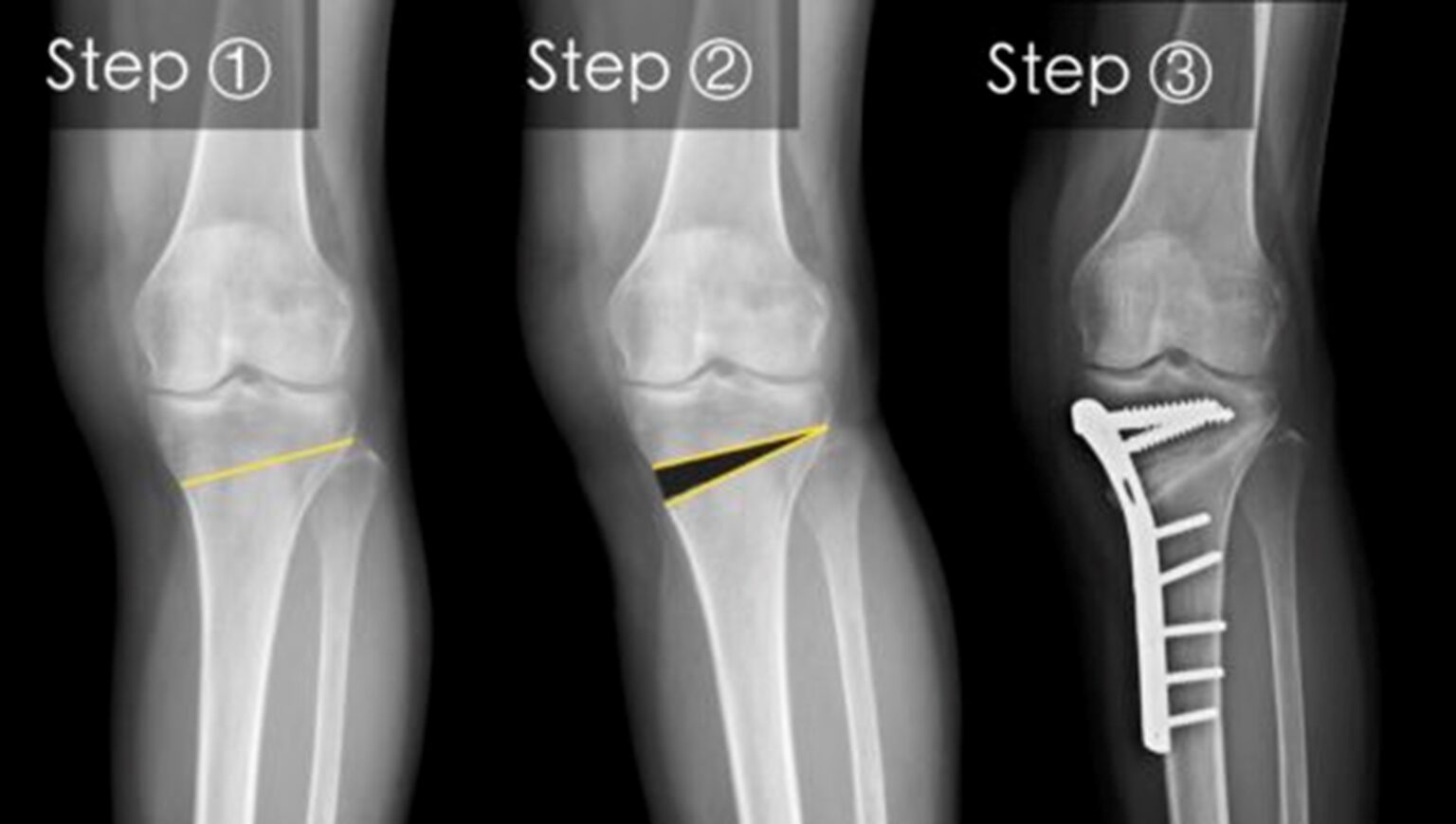 High Tibial Osteotomy HTO Kutch Orthopaedic Hospital